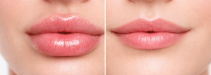 Labios con relleno de ácido hialurónico antes y después mostrando resultado natural y definición estética en clínica profesional